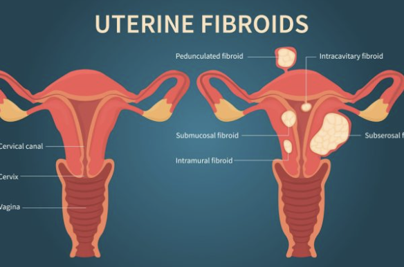 Hysteroscopy (Polypectomy, Myomectomy, Septal Resection) - Specialist Gynaecology Treatment at First Care Clinic
